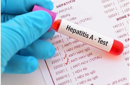 Səhiyyə Nazirliyi hepatit A virusu ilə bağlı məlumat yaydı